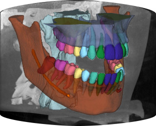 ToothFairy2_MIA